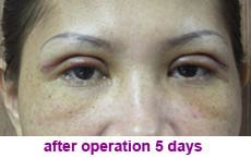 plastic-surgery-blepharoplasty